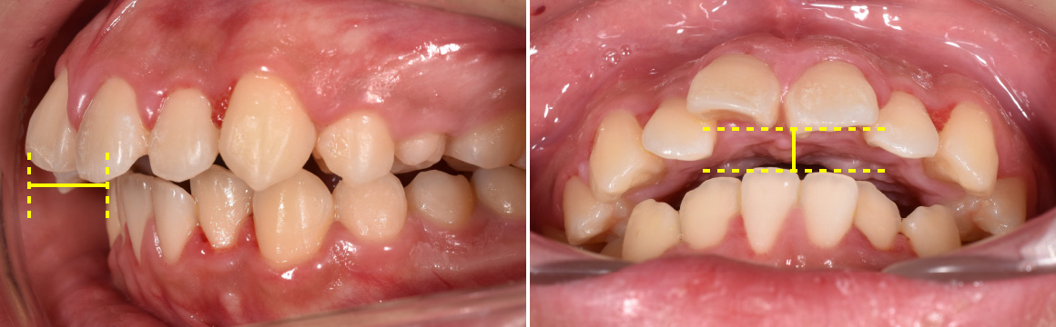 スプリント治療後の歯並び