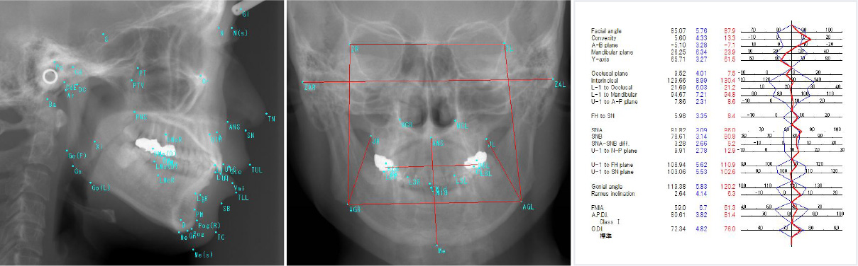 頭部X線装置 セファロレントゲン